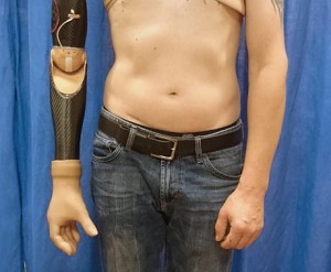 Un braccio protesico comandato da un'interfaccia neurale