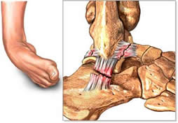distorsione caviglia