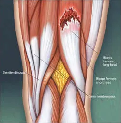 strappo_muscolare